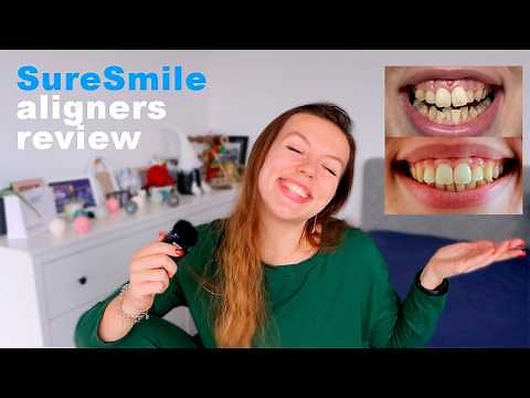 My SureSmile aligners experience | cost, before & after results
