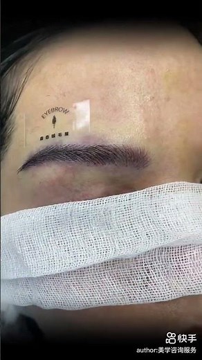 Asian Eyebrow Transplant Results | Before & After Micrograft