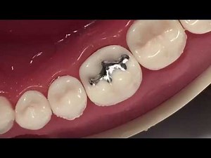 Class I Amalgam Cavity Preparation & Restoration