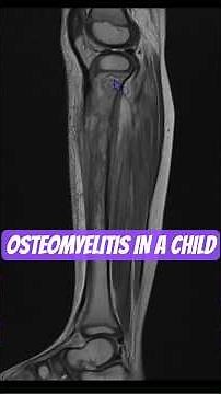 “This Detail Changes Everything in Kids 👀” ✅#msk#mri#acute#infection#radiology#child#pain#growth