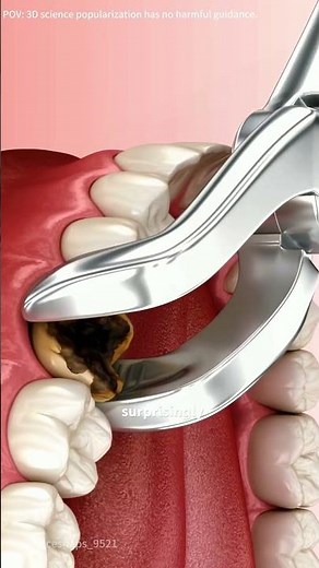 How tooth extraction is done (3 D animation) #medical3danimation #anatomy #medicalanimation