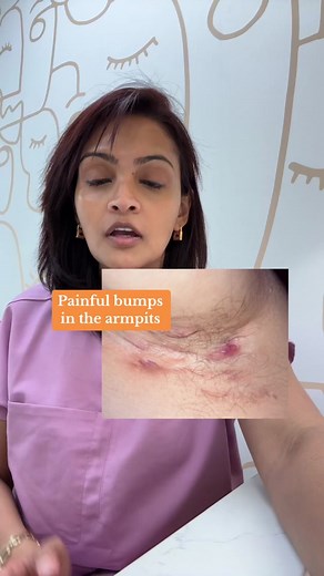 What is hidradenitis suppurativa #hidradenitissuppurativa #hidradenitissuppurativaawareness #hs #armpit #pimples