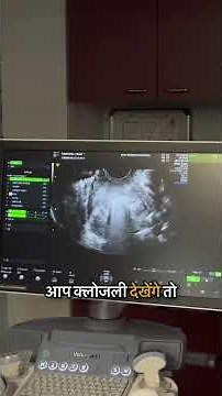 Microwave Ablation Explained!