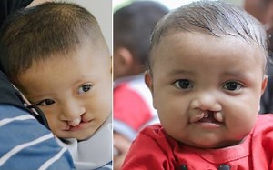 Over five million people living with untreated clefts, study reveals