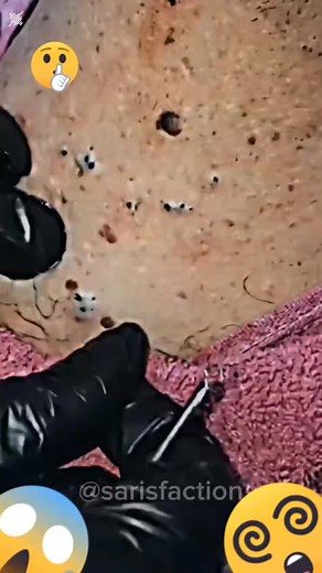 Ultimate Blackhead and Pimple Extractions Compilation