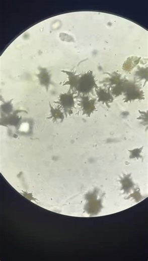 56K views · 377 reactions | Urine microscopy 朗 #lablife #medicallaboratoryscience #Microbiology | Lab life | Facebook