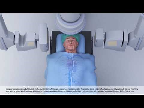 Animation of Thrombectomy Using Aspiration
