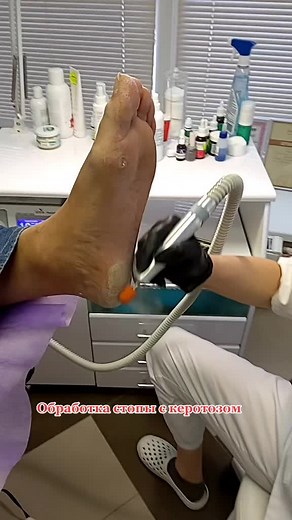 Foot Treatment Procedure: Close-Up Medical Care
