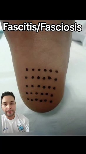 Fasciosis y técnica Topaz en podología