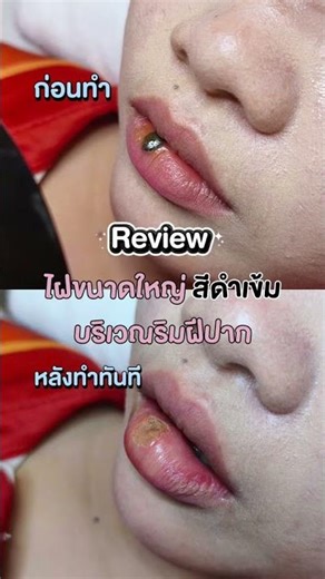 Review of a large, dark mole on the lip. #co2laser #mole removal #mole cauterization #review