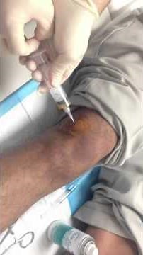 Knee Fluid Drain