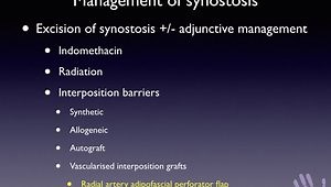 Radial Artery Perforator Adipofascial Flap Interposition toPprevent Recurrence after Resection of Post-Traumatic Radio-Ulnar Synostosis