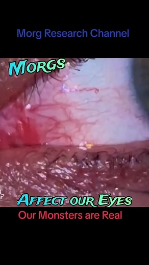 Morgellons victim's eye infested with Morgs. Morgs are microscopic, multicellular, hive-minded, biological animals responsible for Morgellons. The CDC has abandoned its research & others are telling lies. #morgellons #pulsating #morgs #morgresearchchannel #morgshorts #shapeshifter #lights OUR MONSTERS ARE REAL