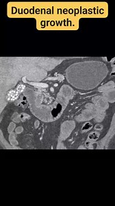6.6K views · 27 reactions | #Duodenum #CTscan #CT #pancreatitis #pancreas | CT Scan and MRI study | Facebook