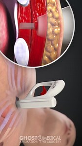 534K views · 1K reactions | AtaCor's pacemaker device provides temporary pacing without needing to enter the heart, vascular system, or cath lab while eliminating the complications associated with transvenous leads and the patient discomfort of transcutaneous pacing. #cardiovascular #heartdevice #medicalanimation #awareness #processvideo | Mix Dancing Events | Facebook