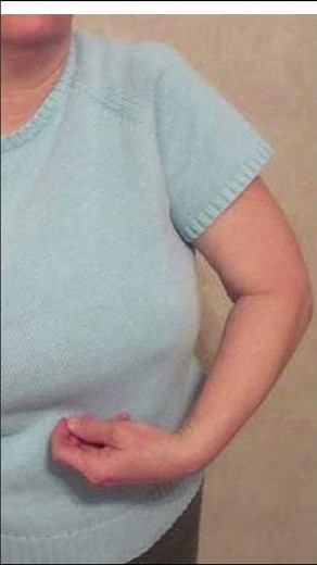 Know the flexor synergy pattern.#bpt #physiotherapy #upperlimb #spasticity