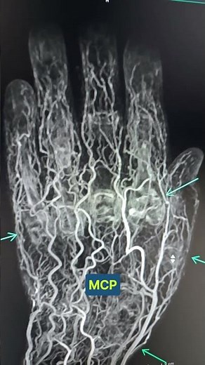 Dynamic map of hand angiography.