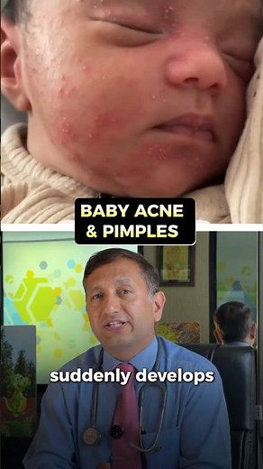 Baby Acne Explained Simply#NewParents #ChildHealth #SkinCare