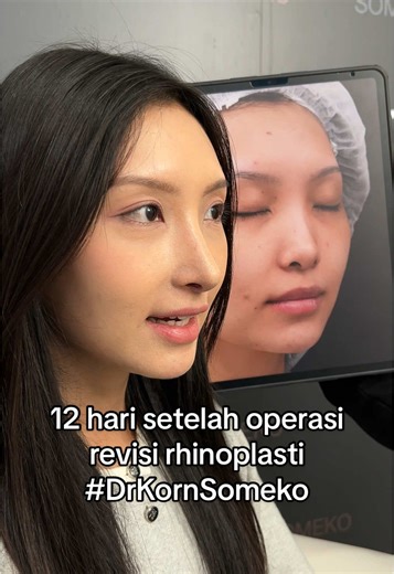 Pengalaman 13 Hari Pasca Operasi Rhinoplasti