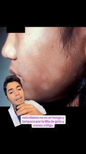 234K views · 18K reactions | Esto no es un #hongo ni por lamida de gato , es algo frecuente !! Mas en este tiempo que se llama pitiriasis alba | Doctor Gabriel Aedo Dermatólogo | Facebook