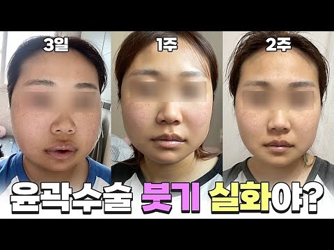 안면윤곽 수술 후 붓기와 회복기간, 케이스별로 알아보기(1일~30일)