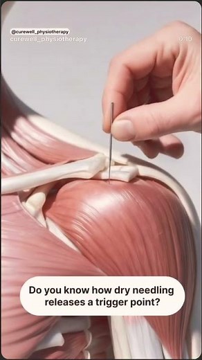“Improving mobility and reducing pain through targeted dry needling.” #physiotherapist #physio