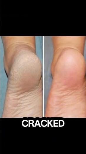 HOW TO HEAL CRACKED HEELS OVERNIGHT | Best Natural Remedy for Dry & Bleeding Feet #footcare