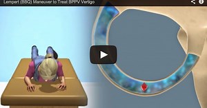 Video of Lempert (BBQ Roll) to Treat BPPV (Horizontal Canal)