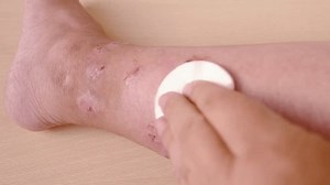 clip-1103440725-closeup-weeping-wounds-venous-ulcers-on-female
