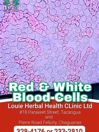 Red and White Blood Cells Part One #drlewis #whitebloodcells #redbloodcells #flu #renal #cellular #foot #bowelpattern #toxicitycheck #immunecompromised #blood #strokerecovery #shilajit #sexualhealth #testimonytime #rheumatiodarthritis #eyeinflammation #plantarfasciitis #drybloodanalysis #kidney #water