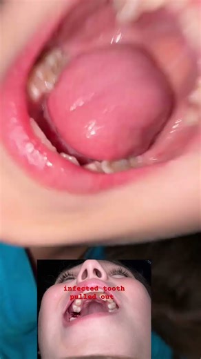 Infected tooth pulled out It was a baby tooth, but it wasn’t ready. not even close ￼