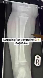 Buckle Fracture in Children: Signs, Diagnosis, and Treatment