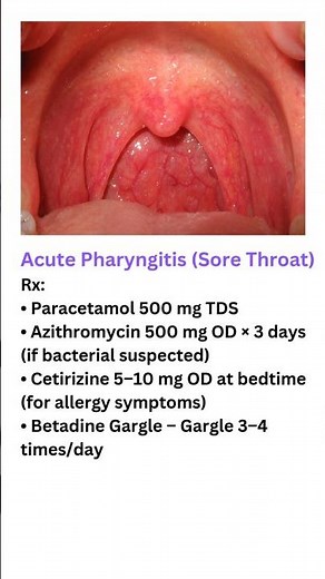 Acute Pharyngitis Treatment | Sore Throat Quick Relief Tips