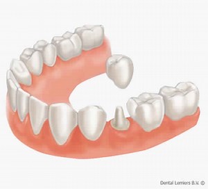Guide complet de la couronne dentaire : utilité et conseils d'entretien