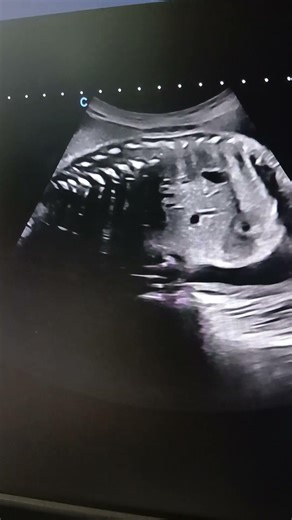 Obstetric ultrasound,vertebral bone