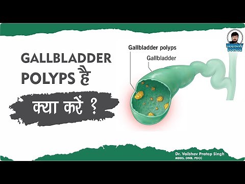 Understanding Gallbladder Polyps || Causes, Symptoms, and Treatment Options