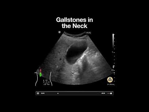 Gallstones in the Neck of the Gallbladder