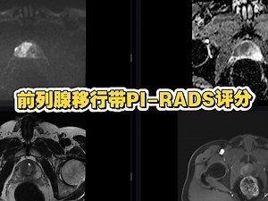 前列腺移行带病灶PI-RADS评分，注意和外周带评分的区别，速来学习吧~