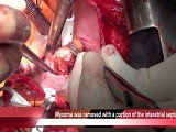 Left Atrial Myxoma Resection • Video • MEDtube.net