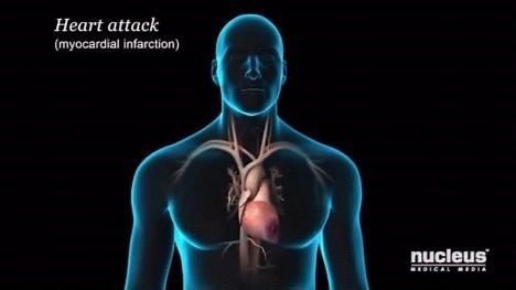 Plaque rupture in coronary artery disease resulting in vessel thrombosis and myocardial infarction. ⠀ ⠀ Remember that time is heart muscle! ⠀ ⠀ It is imperative that blood flow is restored as soon as possible to minimize damage due to ischemia. ⠀ ⠀ ⠀ What would be a cause of this plaque rupture? ⠀ ⠀ Follow @cardiovisual for diabetes and cardiovascular educational content ❤️⠀ .⠀ .⠀ .⠀ #heartattack #myocardialinfarction #cardiac #heart #nurse #studentnurse #nursingstudent #newnurse #cardiologynurs