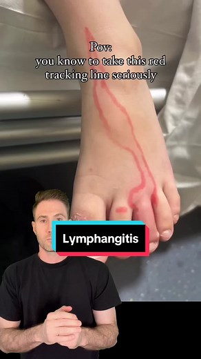 Lymphangitis is an inflammation of the lymphatic vessels, often caused by a bacterial infection, typically Streptococcus or Staphylococcus. It usually presents as red, painful streaks on the skin extending from the site of infection toward nearby lymph nodes, which may also become swollen and tender. Fever, chills, and a general sense of illness may accompany these symptoms. Prompt treatment with antibiotics is essential to prevent they infection from spreading and to avoid potential complicatio