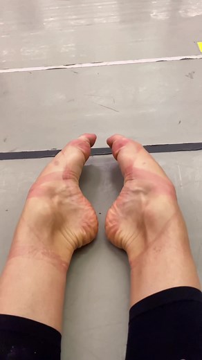 The Painful Reality of Ballerina Feet After Hours of Rehearsal
