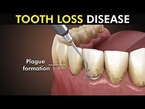 Periodontitis or Gum disease: 3d animation included
