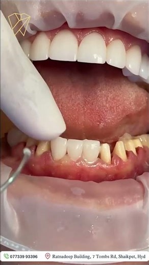 E-max Crowns Explained | Natural-Looking, Strong & Long-Lasting Dental Crowns | #dentist