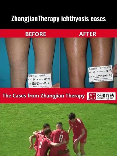 Zhangjian Therapy ichthyosis treatment cases #ichthyosisvulgaris #ichthyosis