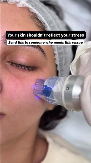 Scarlet RF Microneedling to bring back smooth, radiant skin for her. 💥
