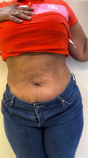 La Evaluación es Gratuita incluye evaluación nutricional evaluación en aspecto estético,le realizamos Inbody que es un scanner Corporal y si es necesario le realizamos Sonografia con nuestro equipo Clarius para citas: 829-757-7005#clinicadenutricionymedicinaesteticadrcasanova #republicadominicana🇩🇴 #sinriesgos #bellezza #medicinaestètica