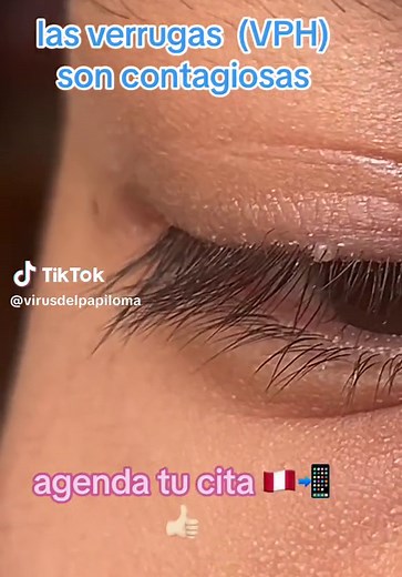 Eliminación de verrugas del VPH en párpados