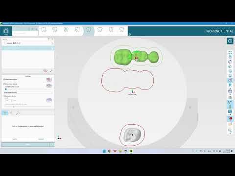 1.1 Zirconia Crown & Bridge - WorkNC Dental Training Video