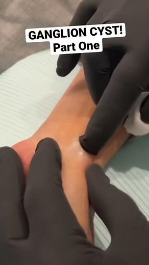 SHORT: GANGLION CYST!